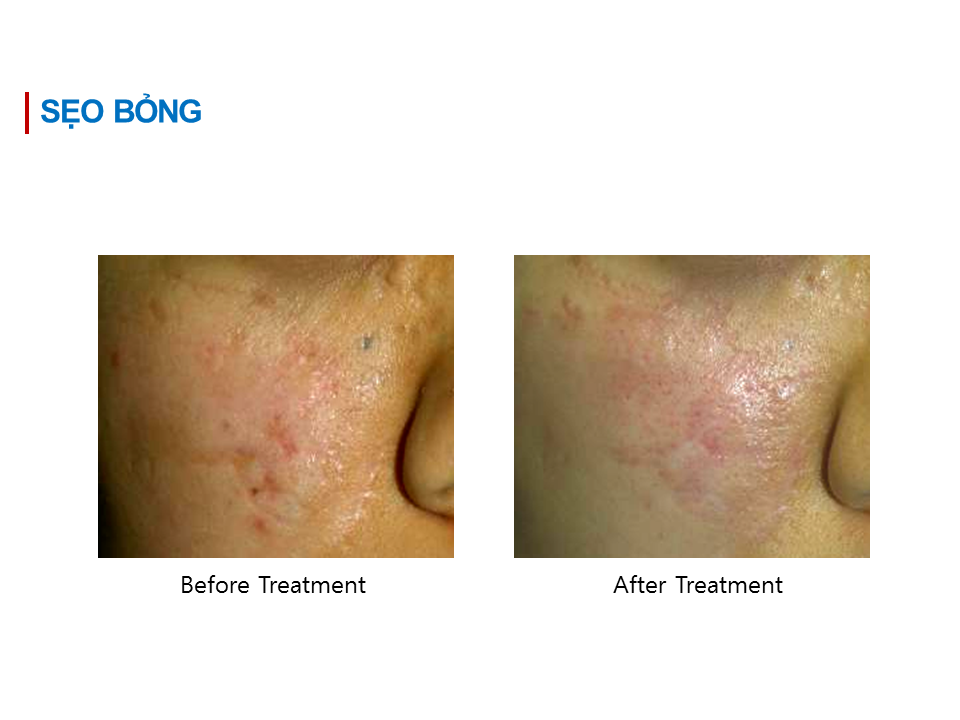 sẹo bỏng Laser Fractional CO2 - Odyssey